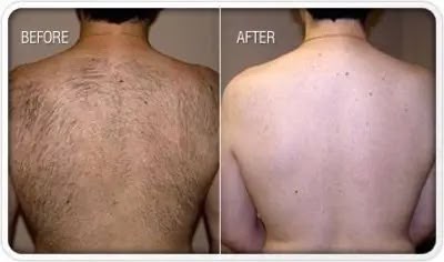 Laser Hair Reduction Vadodara